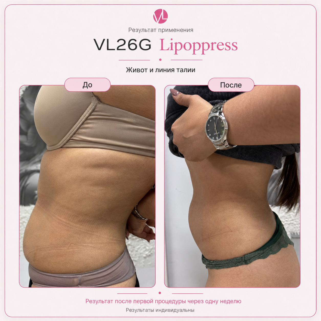 VL26G Lipoppress — результат через одну неделю