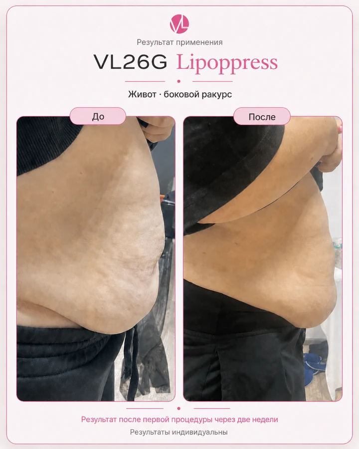 VL26G Lipoppress: живот, сравнение через две недели после первой процедуры