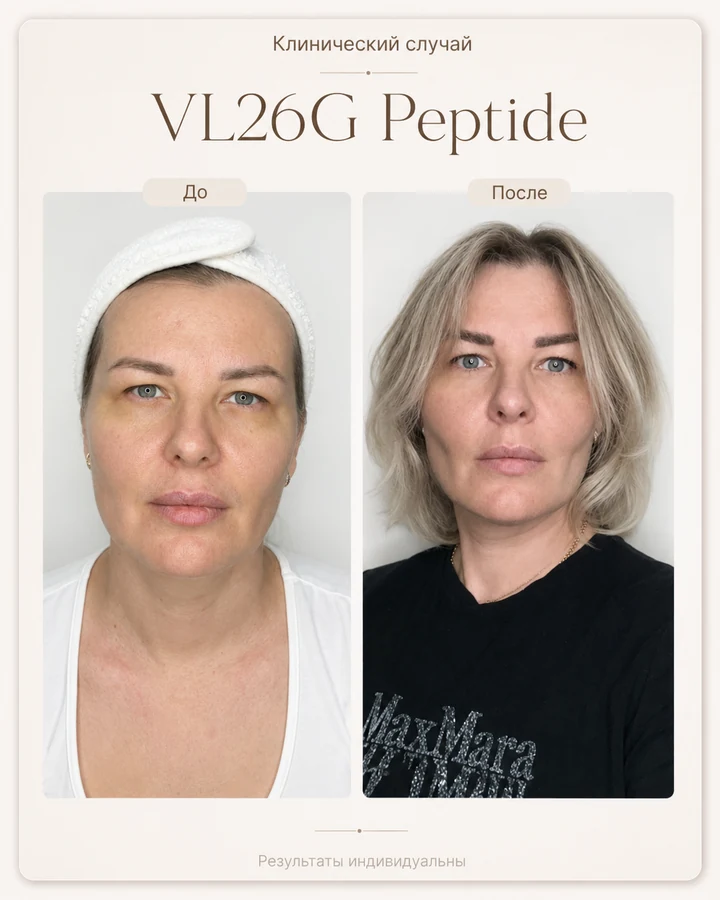 VL26G Peptide: сравнение фотографий лица через одну неделю