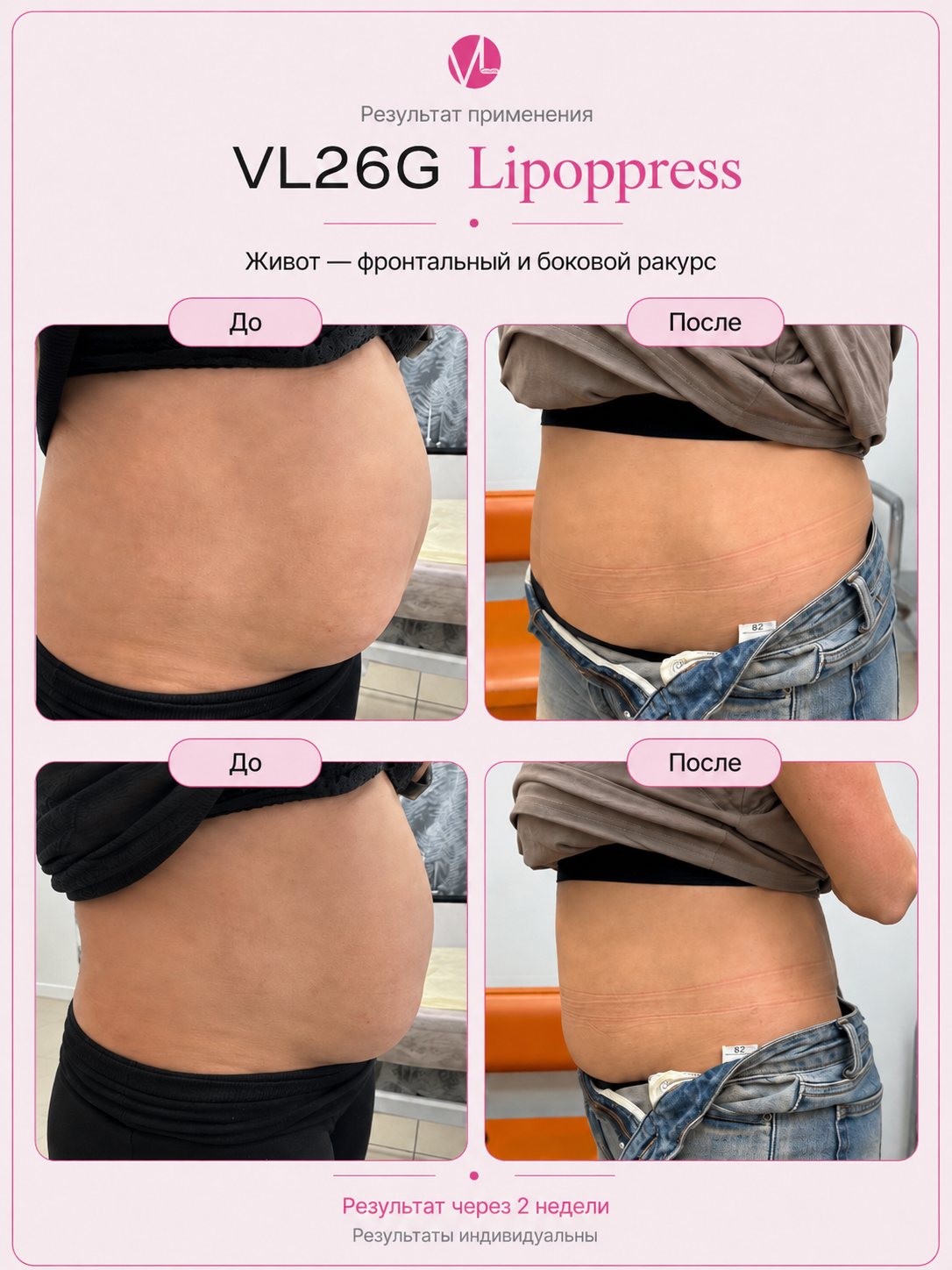 VL26G Lipoppress — результат через две недели