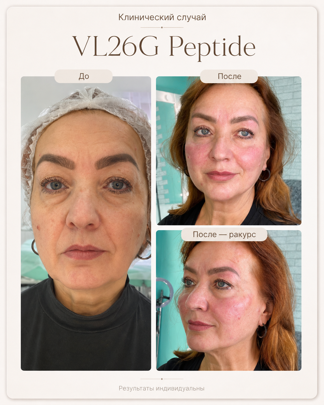 VL26G Peptide — результат после первого применения