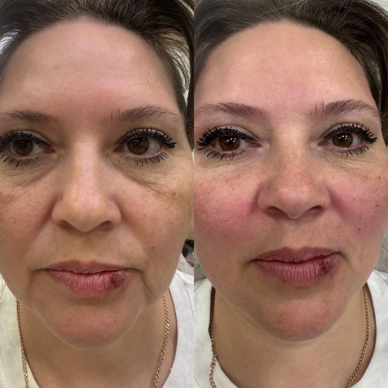 VL26G Peptide — коррекция асимметрии лица после ботулинотерапии