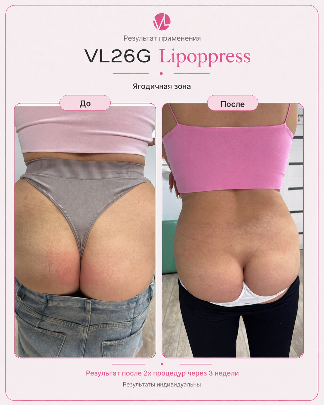 VL26G Lipoppress — результат после двух процедур